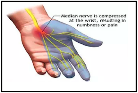 carpal-tunnel-syndrome